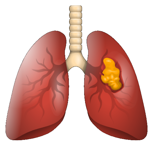 Ilustración de Tratamiento del cáncer pulmonar por mínima invasión