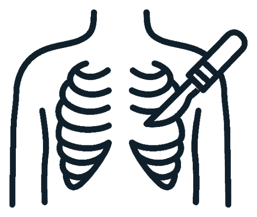 Ilustración de cirugía torácica