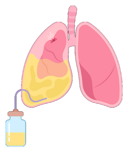 Ilustración de Tratamiento del derrame pleural