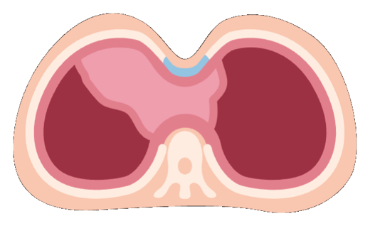 Ilustración de Tratamiento quirúrgico de pectus