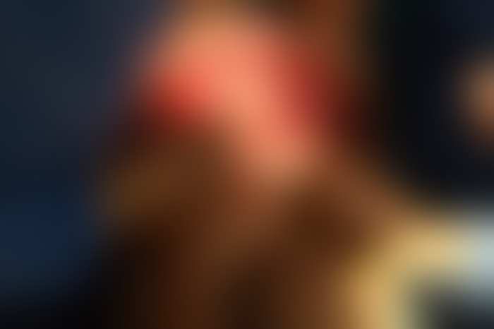 Fotografía clínica difuminada del campo quirúrgico abierto durante un trasplante pulmonar — clic para revelar